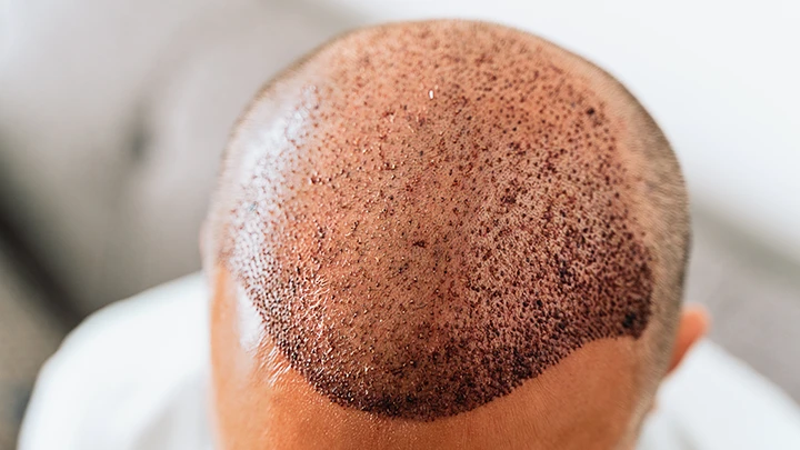 Micropigmentación capilar